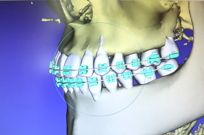 3Dデジタル矯正システム