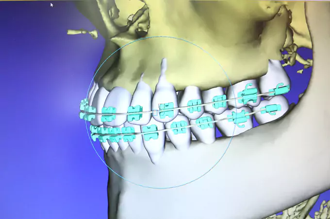 3Dデジタル矯正システム